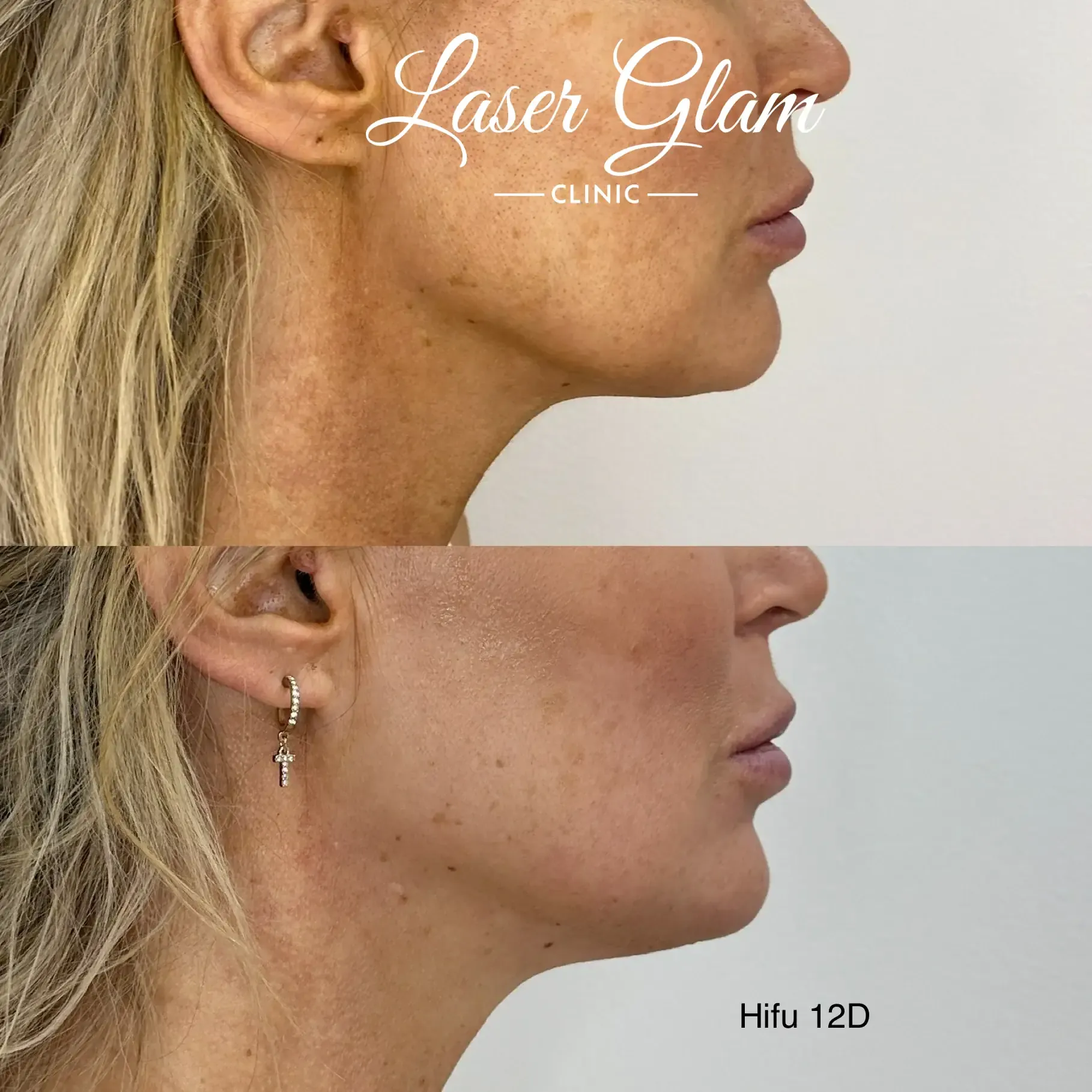 Före och efter HIFU 12D