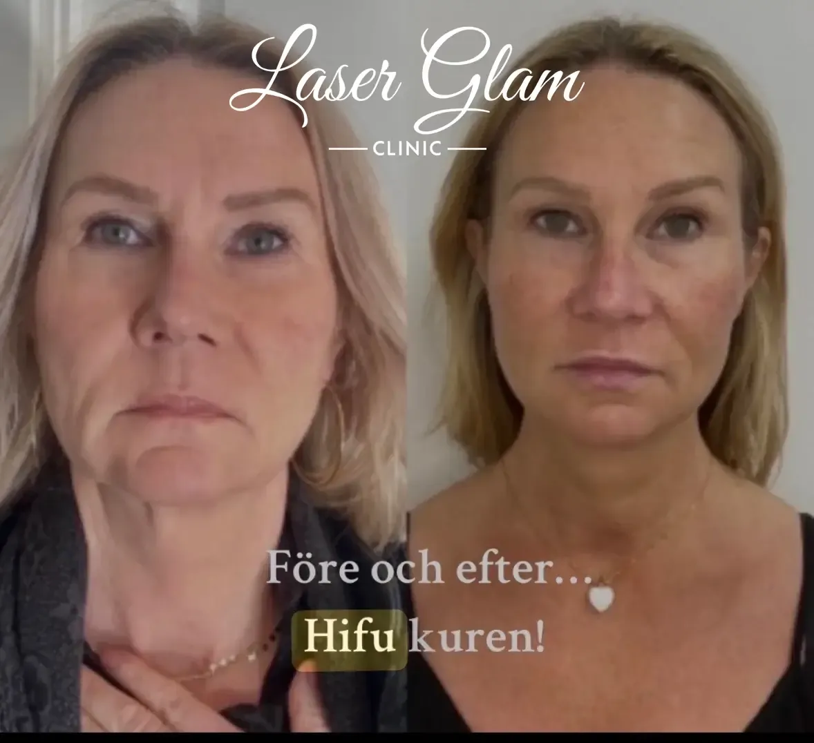Före och efter HIFU, ansikte och käklinje